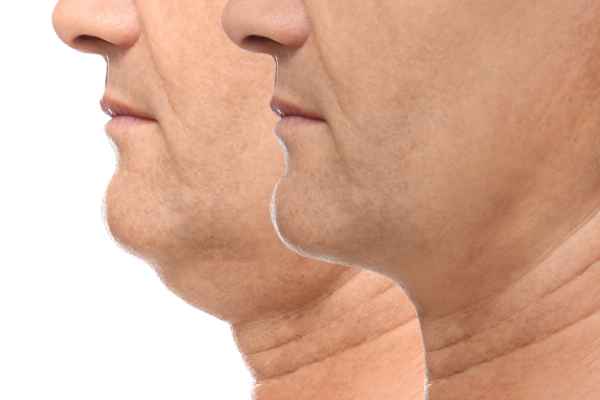 HIFU - Breakthrough in Anti - ageing 2 hifu results Romford