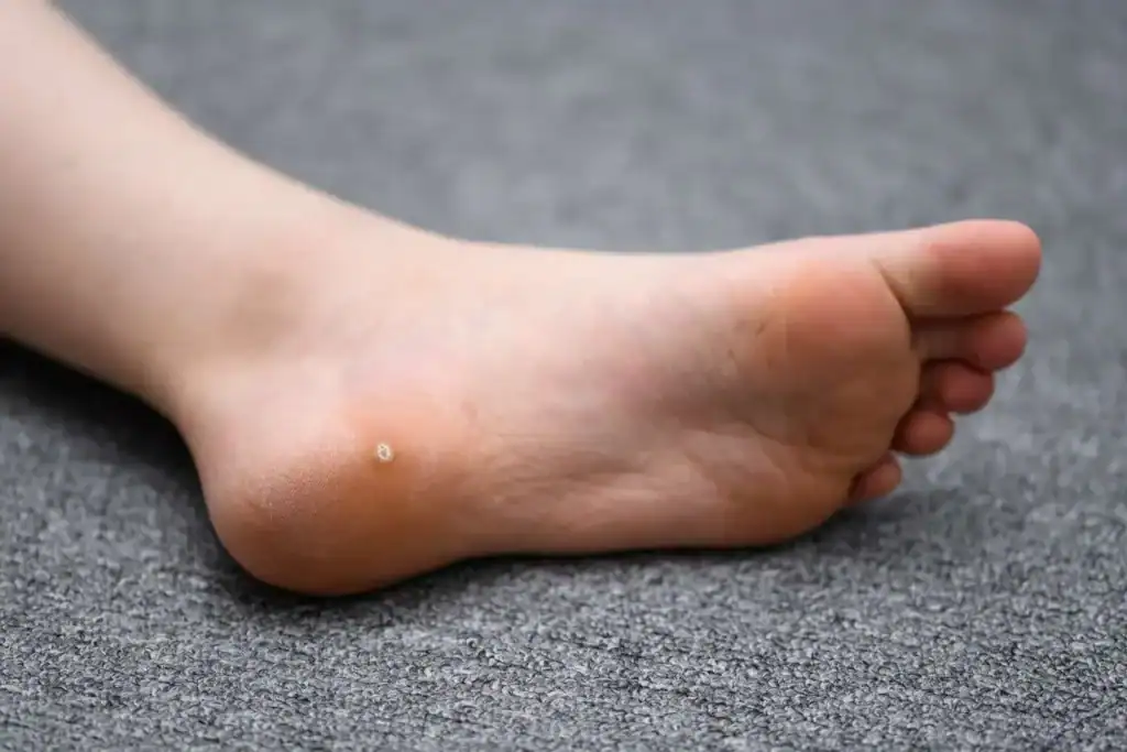 Cryotherapy For Warts And Also Verrucas 2 Image of verruca on the bottom of the foot that able to be treated with Cryotherapy Romford