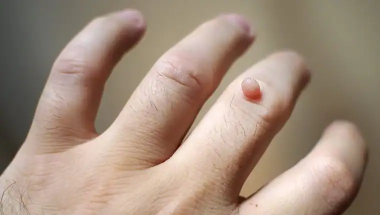 Cryotherapy For Warts And Also Verrucas 1 Image of blemish that Cryotherapy Romford can remove with Lipo 360.
