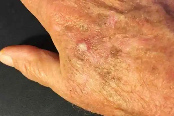 Image of Actinic keratoses Romford on a person hand
