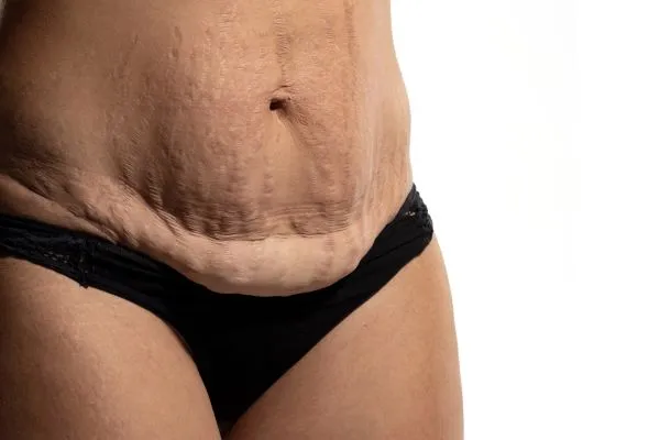 The Science of Skin Tightening 1 The science behind skin tightening Romford picture of a woman's sagging skin on the stomach
